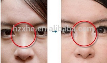 hyaluronic acid nose filler hump nose nose up