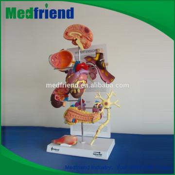 MFM009 Wholesale From China Model Of Diabetes