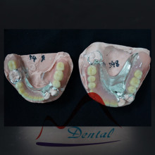 Fit CoCr Casting Partial Denture