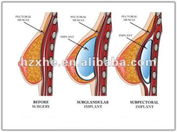 Cross-linked Hyaluronic Acid Injectable Breast Filler