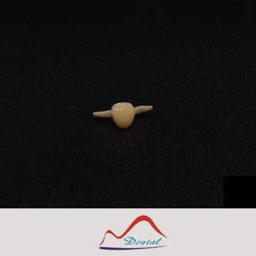 Zirconia Maryland Bonded Bridge