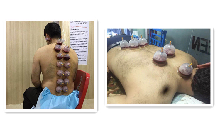 Home Use Chinese Traditional  Cupping Therapy set with cupping Set for body