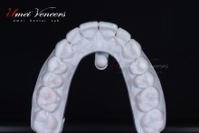 Comfortable and painless veneers