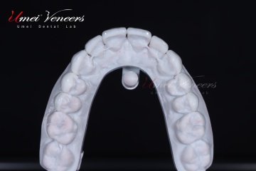 Comfortable and painless veneers