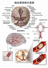 3D Medical Anatomical PVC Chart - Brain Disease (JLY-C001)