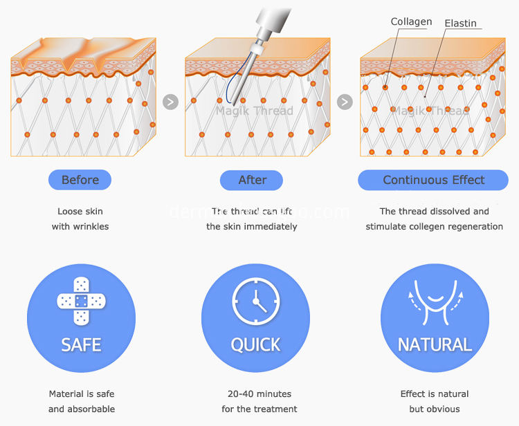 Pdo Face Lifting Treatment