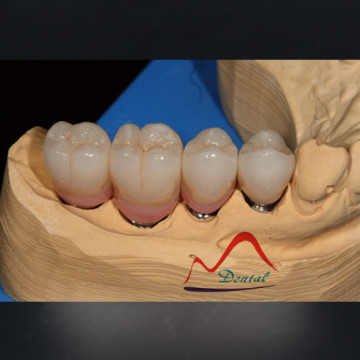 Zirconia dental implant crown and bridge