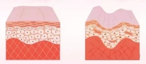 Rekombinant tip ⅲ İnsanlaştırılmış kollajen yara sosu Recombinant type Ⅲ humanized collagen wound dressing