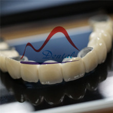 Life like PFM Crown and Bridge