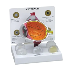 High Quality Large-Scale Human Cataract Eye Model