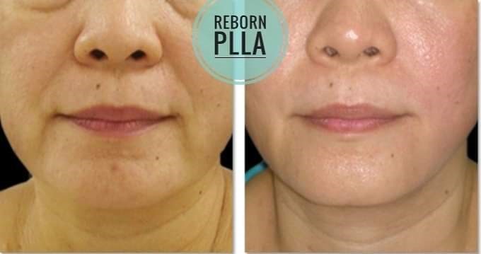 dermal filler for promote collagen