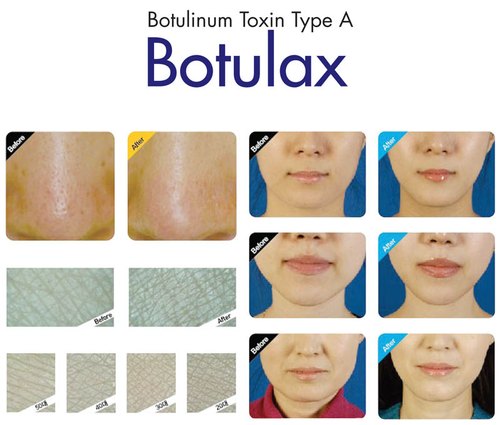 botulux-100-u-500x500