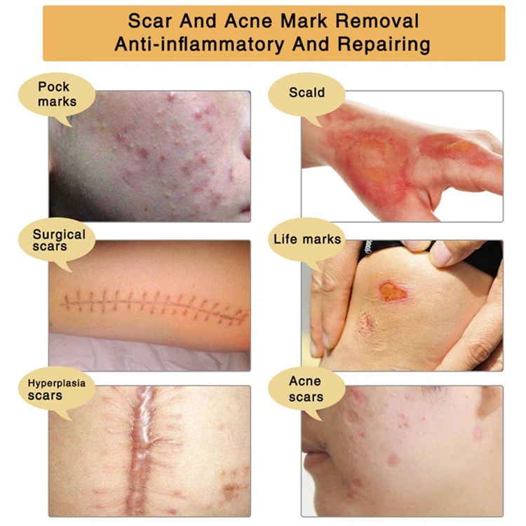 OEM/ODM Tcm Scar and Acne Marks Removal Gel Cream for Face & Body