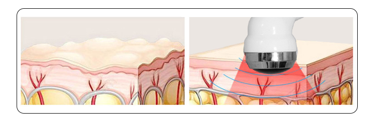 Microdermabrasion Jet Peel