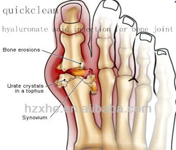 HA injection for bone joint(quickclean)