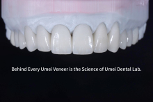 Ultra-thin aesthetic restorative veneers