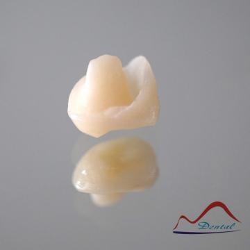 IPS E.max? Press Onlay