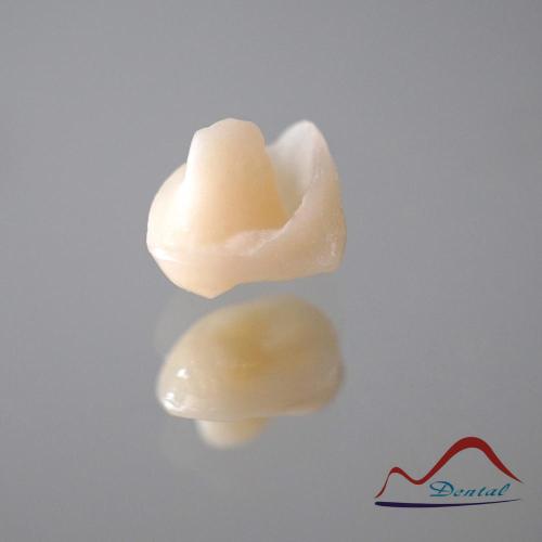 IPS E.max® Press Onlay
