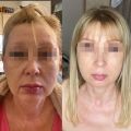 Reborn PLLA Polymer Wrinkle Removal Fillers for Face