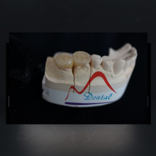 High strength IPS Emax Onlay and Inlay