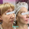 Forehead Wrinkle Removal Dermal Filler For Face Rejuvenation