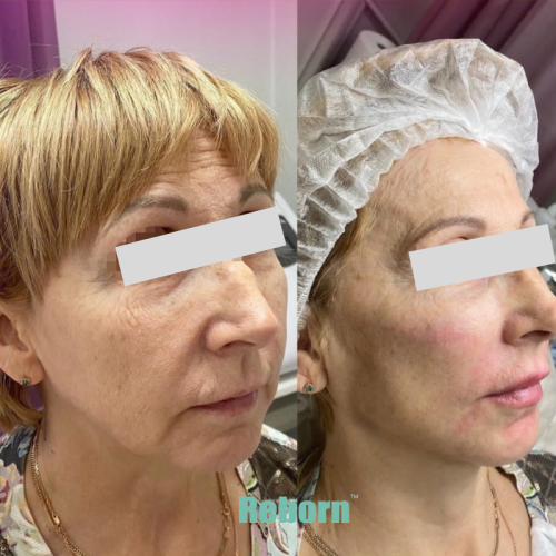 Anti Aging PLLA Dermal Filler for Face Skincare