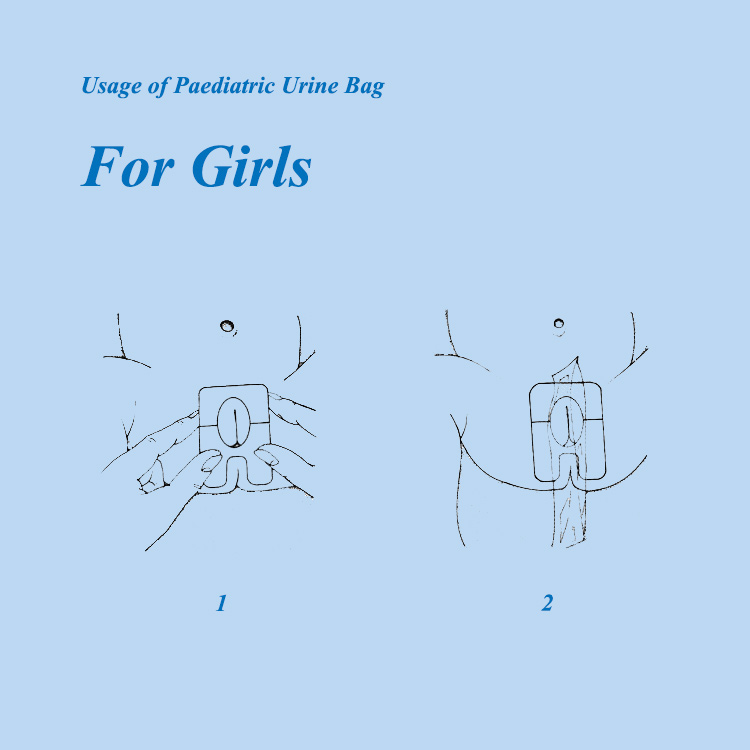 Usage of Paediatric Urine Bag for Girls