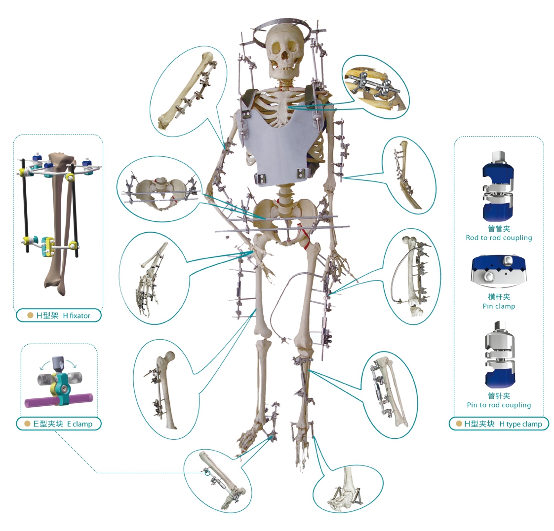 Fixator System