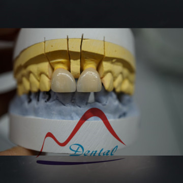 Zirconia crown and bridge imported material
