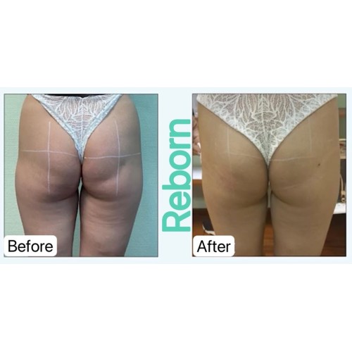 Non-Surgery Body Contour Treatment For Buttocks Enhancement