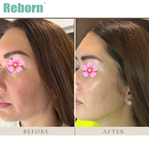Injection technique with Reborn plla filler