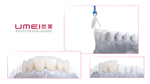 Conception de la couronne de placage