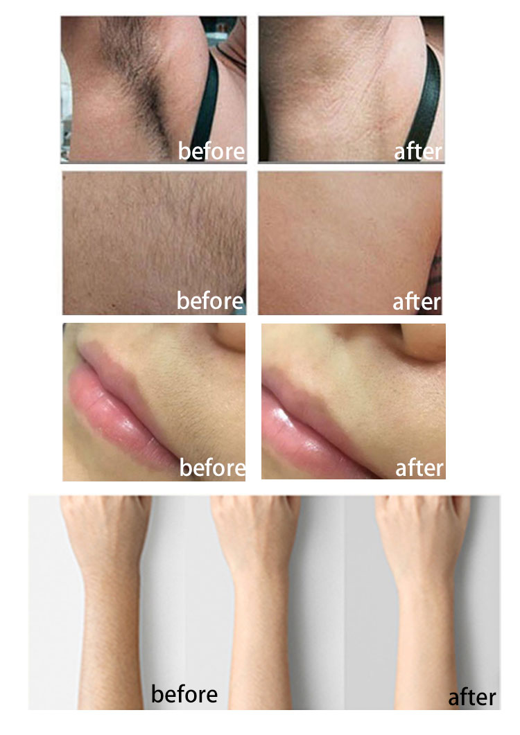 Depilación láser Flash N Go Flash N Go Laser Hair Removal