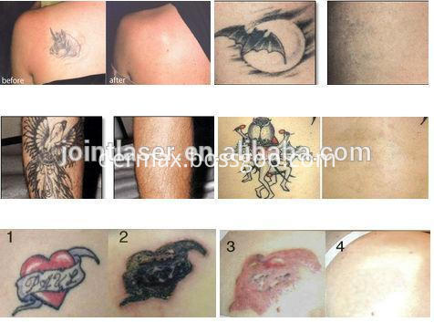 Tattoo Removal Before and After