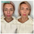 Marionette lines removal dermal filler