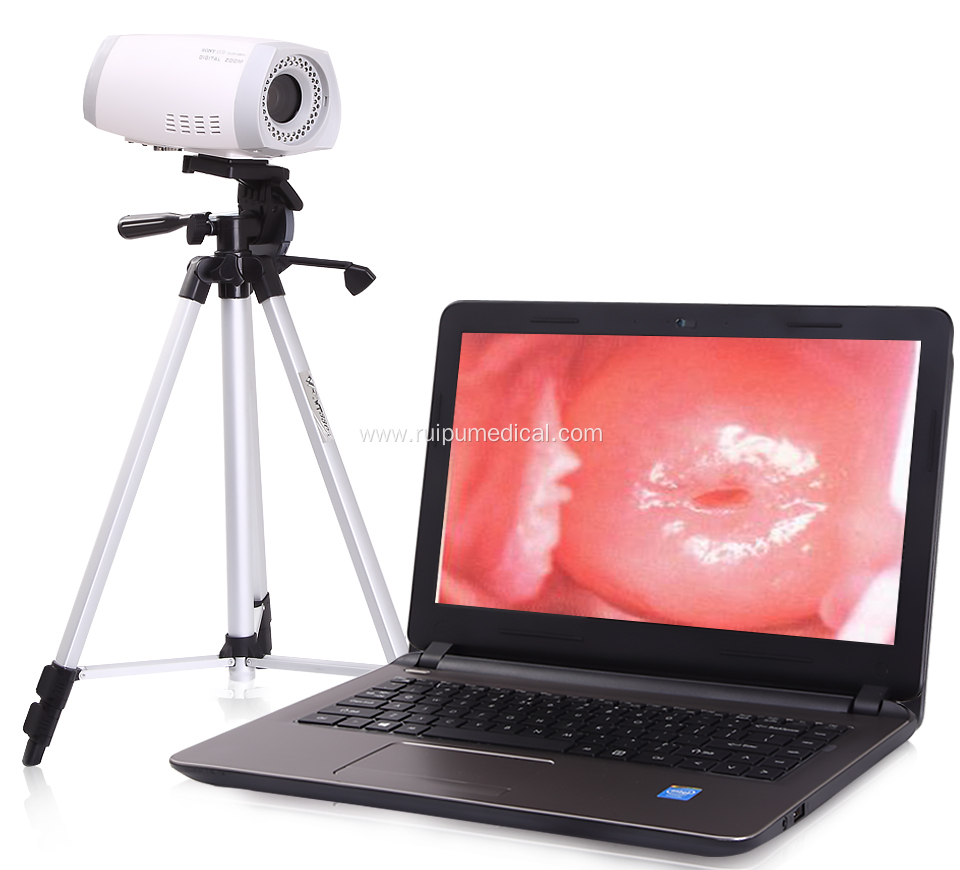 Medical Digital Portable Video Colposcope for Gynecology