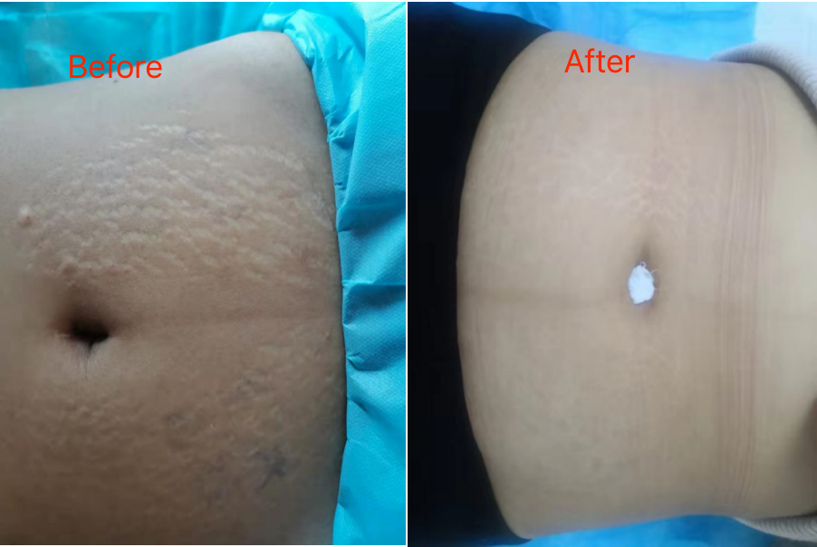 stretch marks removal