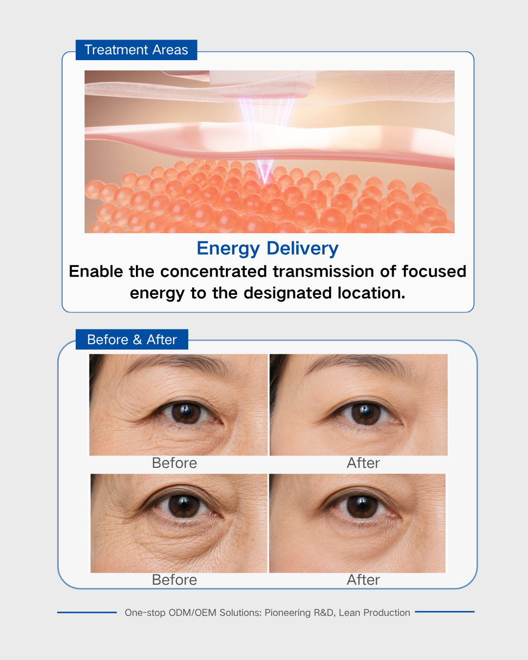 Periorbital Sıkılaştırma için Ultherapy Dönüştürücü -2 Ultherapy Transducer for Periorbital Tightening -2