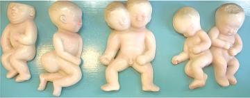 Fetal malformation model(4 parts)