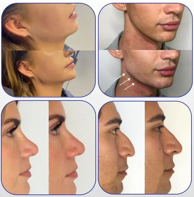 Elasty-Filler ELS(15) Elasty-Filler Els (15)