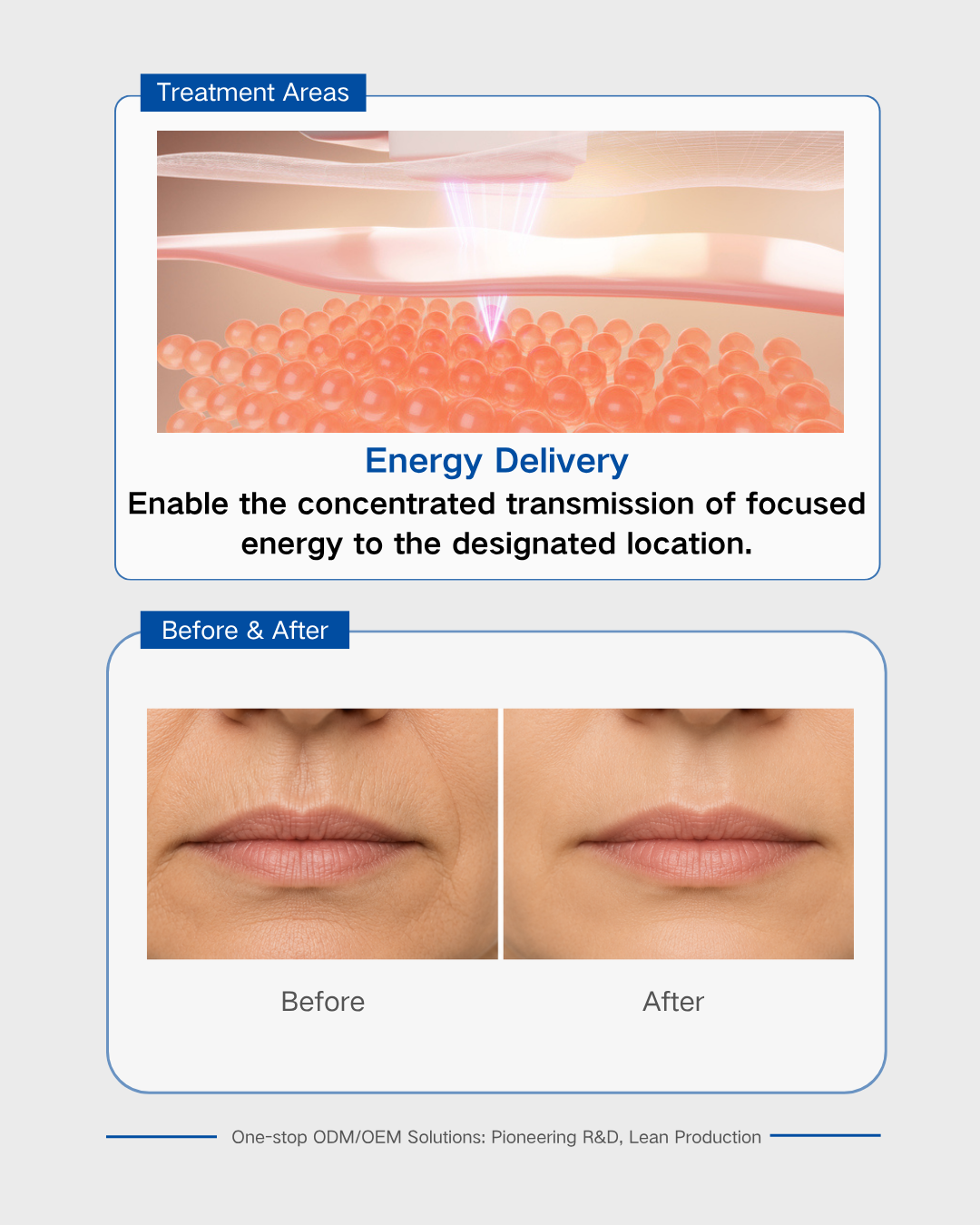 Yerel Sıkma Odaklı Ultrason Dönüştürücü Local Tightening Focal Ultrasound Transducer