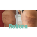 Non-Surgery Body Contour Treatment For Buttocks Enhancement