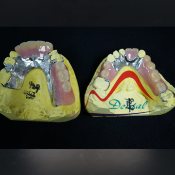 Fine Quality Partial Framework Removable Denture