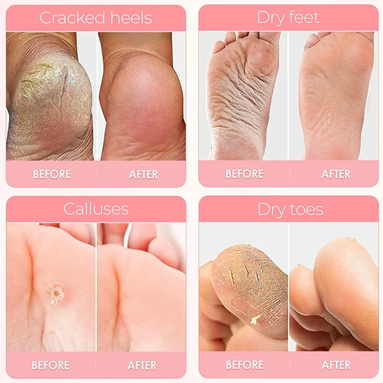 OEM Exfoliating Peeling Natural Treatment Cracked Heels Foot Peel Mask