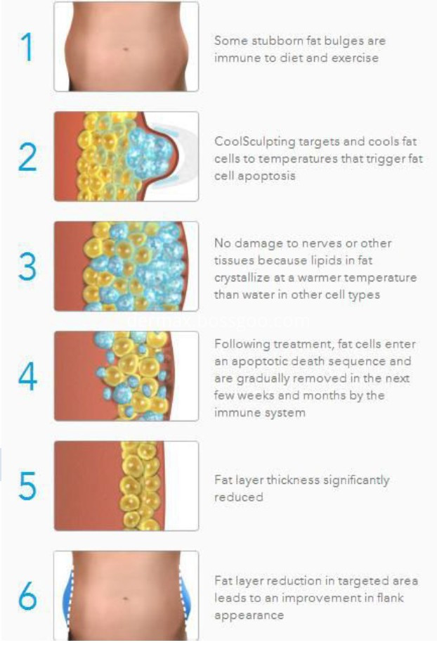 Cryolipolysis