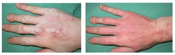 Effective cure for psoriasis-311nm psoriasis laser-do not need psoriasis cream anymore