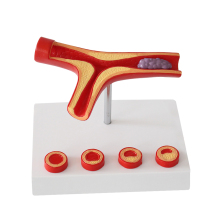 50 Times Enlarged Human Vessel Atherosclerosis Vascular Model Medical Supplies