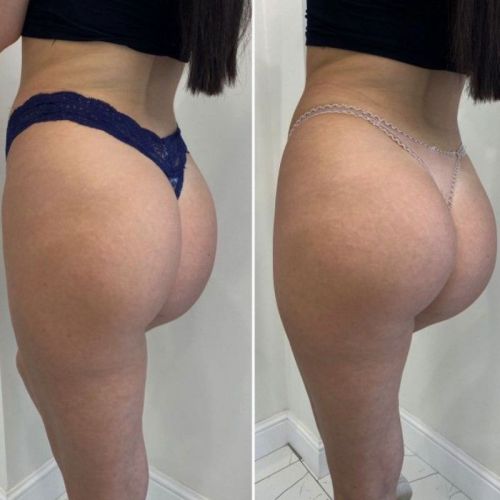 Injectable Perfect Body Aesthetics For Buttocks Augmentation