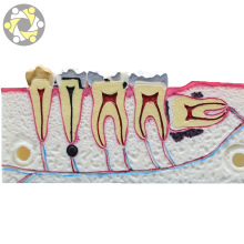Medical Supplier Dental Pathology Teeth Comparison Study Model