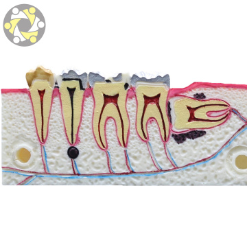 Medical Supplier Dental Pathology Teeth Comparison Study Model
